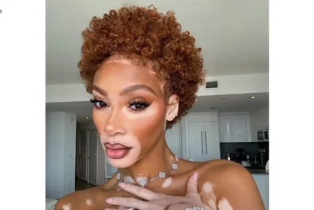 Winnie Harlow
